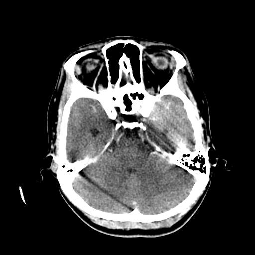 File:Choriocarcinoma of ovary with cerebral and pulmonary metastases (Radiopaedia 25983-26118 C+ arterial phase 46).jpg