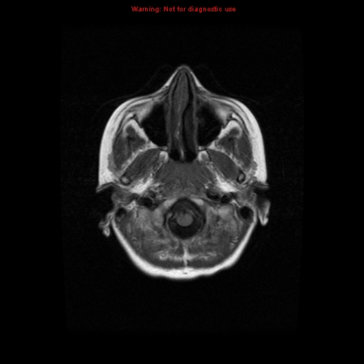 File:Choroid plexus carcinoma - recurrent (Radiopaedia 8330-9169 Axial T1 2).jpg