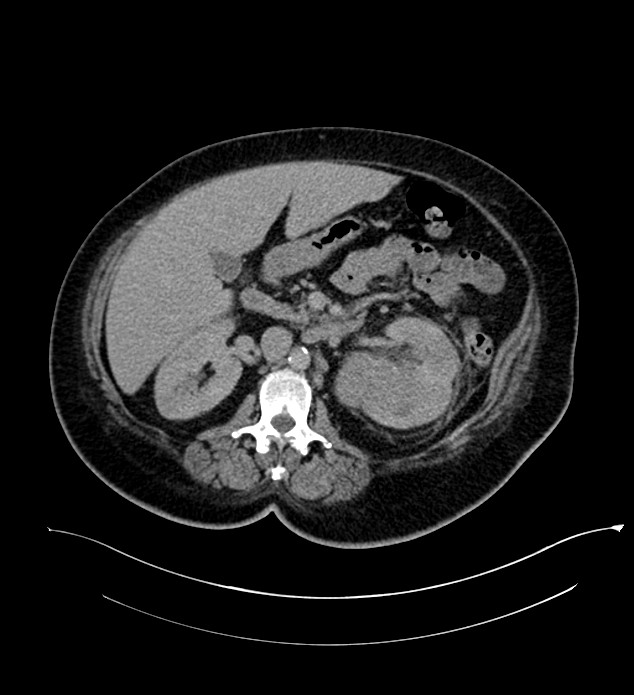 Chromophobe renal cell carcinoma (Radiopaedia 84239-99519 E 73).jpg