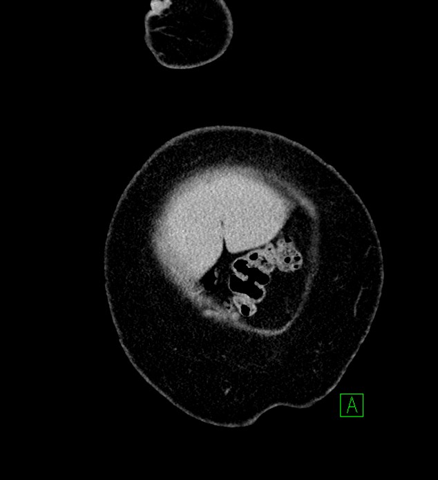 Chromophobe renal cell carcinoma (Radiopaedia 84239-99519 F 5).jpg
