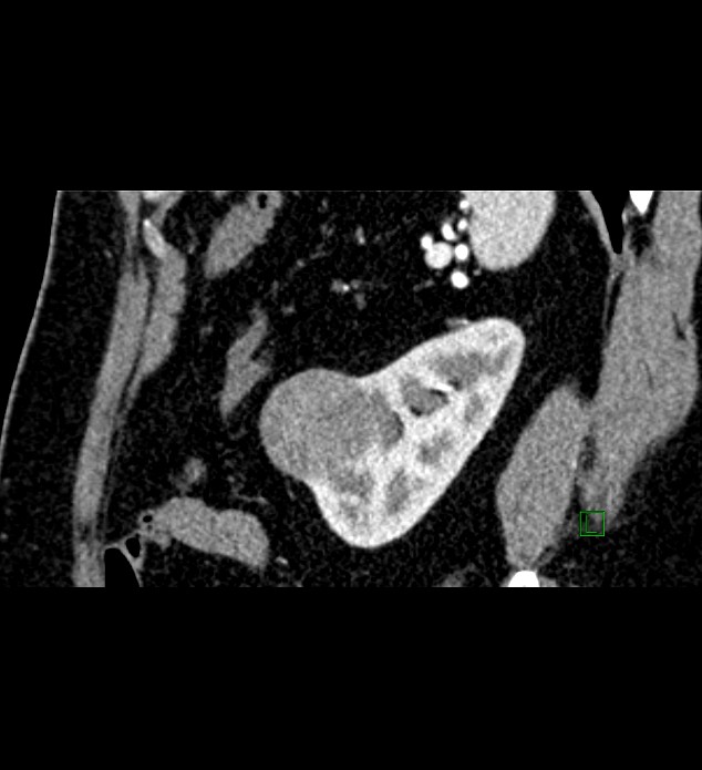 Chromophobe renal cell carcinoma (Radiopaedia 84286-99573 F 38).jpg