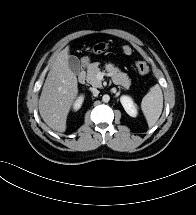 Chromophobe renal cell carcinoma (Radiopaedia 84286-99573 G 23).jpg