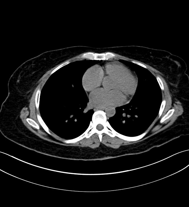 Chromophobe renal cell carcinoma (Radiopaedia 84290-99582 Axial non-contrast 3).jpg