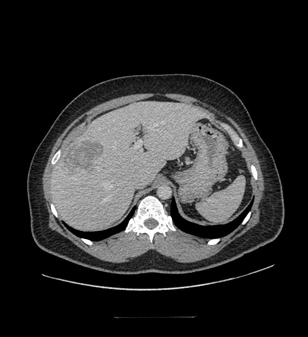 Chromophobe renal cell carcinoma (Radiopaedia 84337-99644 C 31).jpg