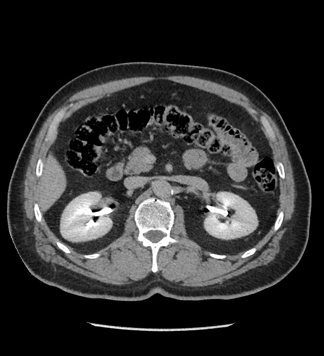 Chromophobe renal cell carcinoma (Radiopaedia 86879-103083 D 54).jpg