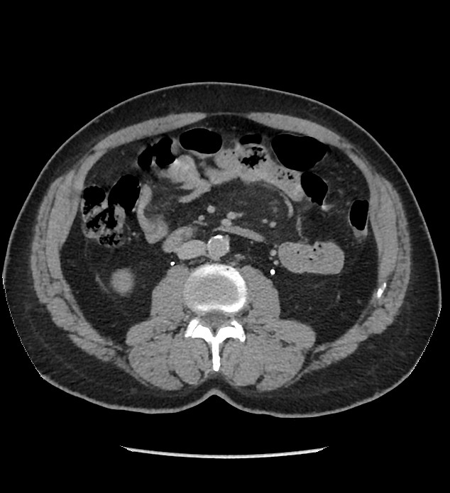 Chromophobe renal cell carcinoma (Radiopaedia 86879-103083 D 72).jpg