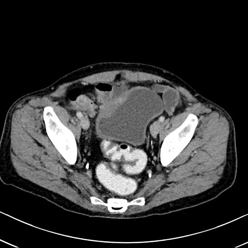 Chronic appendicitis complicated by appendicular abscess, pylephlebitis and liver abscess (Radiopaedia 54483-60700 B 125).jpg