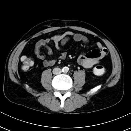 Chronic appendicitis complicated by appendicular abscess, pylephlebitis and liver abscess (Radiopaedia 54483-60700 B 91).jpg