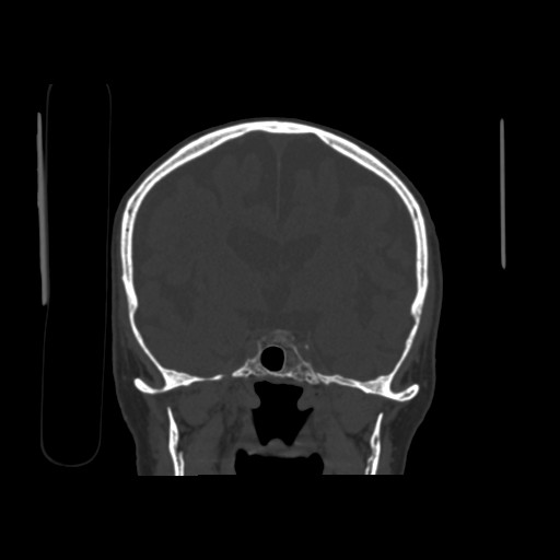 File:Chronic bilateral subdural hygroma (Radiopaedia 85801-101623 Axial bone window 1).jpg