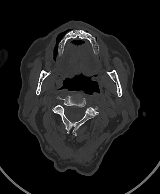 Chronic bilateral subdural hygroma (Radiopaedia 85801-101623 Axial bone window 129).jpg