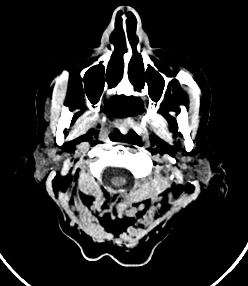 Chronic bilateral subdural hygroma (Radiopaedia 85801-101623 Axial non-contrast 61).jpg