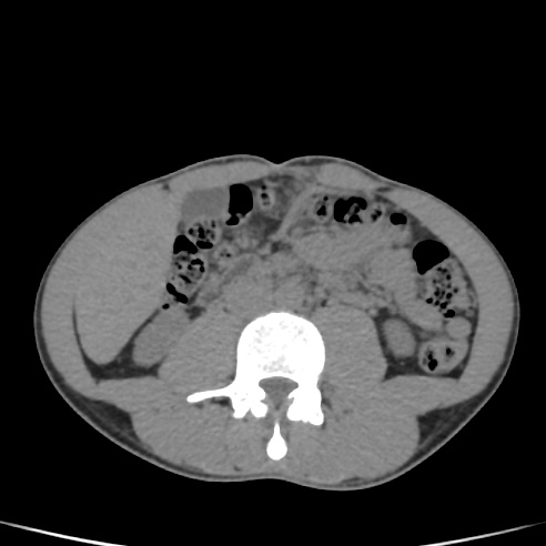 File:Chronic calcific pancreatitis (Radiopaedia 56280-62953 Axial non-contrast 34).jpg
