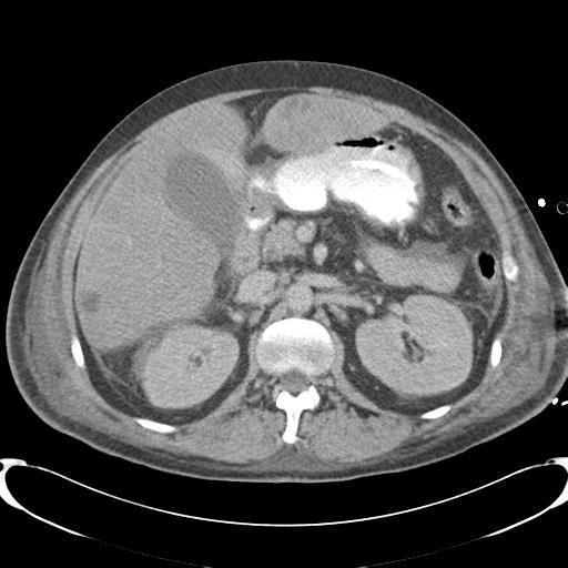 Chronic diverticulitis complicated by hepatic abscess and portal vein thrombosis (Radiopaedia 30301-30938 A 37).jpg