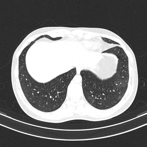 Chronic eosinophilic pneumonia (Radiopaedia 39331-41587 Axial lung window 45).png