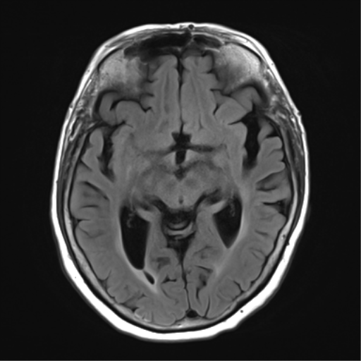 File:Chronic hypertensive encephalopathy (Radiopaedia 39993-42482 Axial FLAIR 12).png
