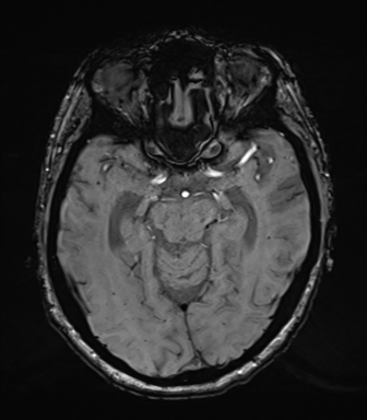 Chronic hypertensive encephalopathy (Radiopaedia 39993-42482 Axial SWI 34).png