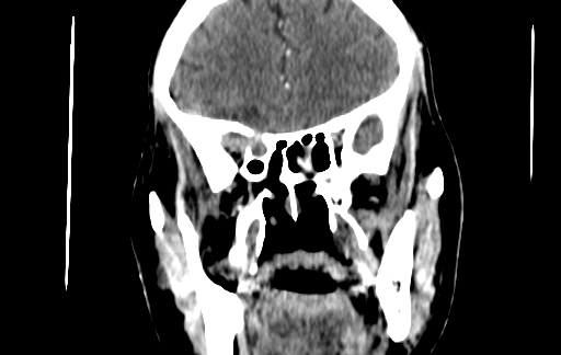Chronic invasive fungal sinusitis (Radiopaedia 91563-109286 D 66).jpg