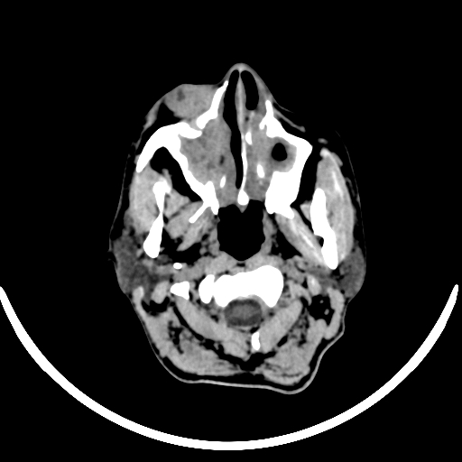 File:Chronic invasive fungal sinusitis with intraorbital and intracranial extension (Radiopaedia 56387-63046 Axial non-contrast 52).jpg