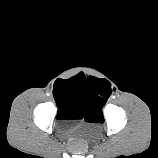 File:Chronic large bowel pseudo-obstruction (Radiopaedia 43181-46492 A 150).jpg
