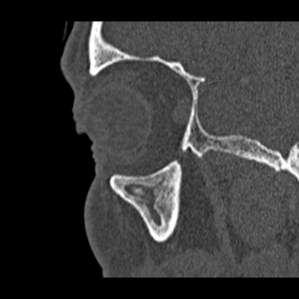 Chronic maxillary sinusitis (Radiopaedia 27879-28116 Sagittal bone window 50).jpg