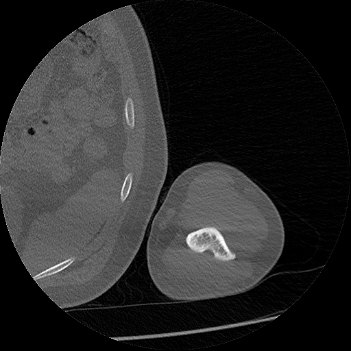 Chronic osteomyelitis (Radiopaedia 67597-76998 Axial bone window 61).jpg