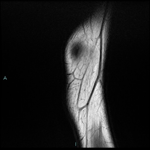 File:Chronic osteomyelitis (with Brodie abscess) (Radiopaedia 76405-88112 Sagittal PD 1).jpg