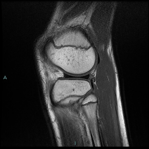 File:Chronic osteomyelitis (with Brodie abscess) (Radiopaedia 76405-88112 Sagittal PD 21).jpg