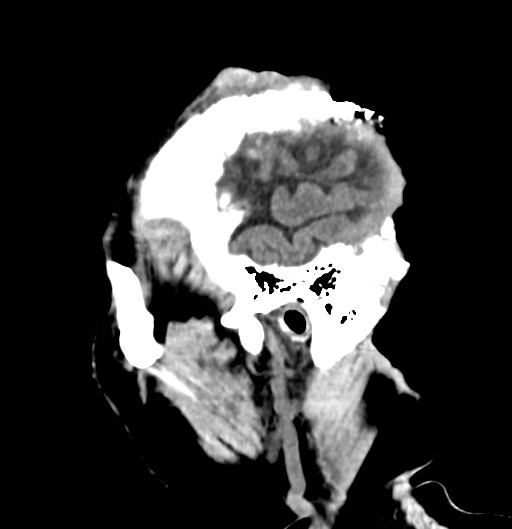 Chronic osteomyelitis - calvarial (severe) (Radiopaedia 69668-79616 D 51).jpg