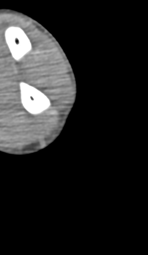 Chronic osteomyelitis of the distal humerus (Radiopaedia 78351-90971 Axial non-contrast 139).jpg