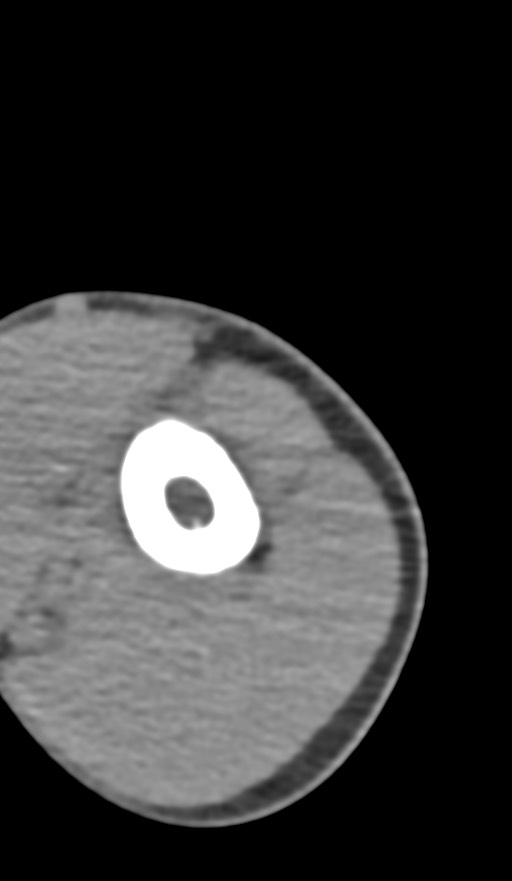 Chronic osteomyelitis of the distal humerus (Radiopaedia 78351-90971 Axial non-contrast 30).jpg