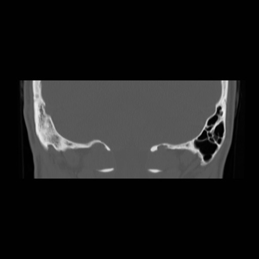 File:Chronic otomastoiditis (Radiopaedia 27138-27309 Coronal bone window 23).jpg