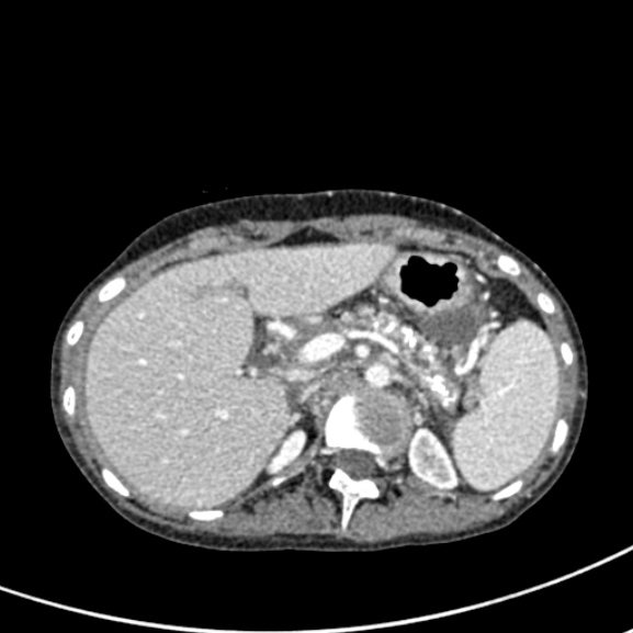File:Chronic pancreatitis (Radiopaedia 55405-61846 A 31).jpg