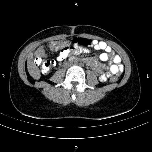 Chronic pancreatitis (Radiopaedia 64576-73450 Axial non-contrast 92).jpg