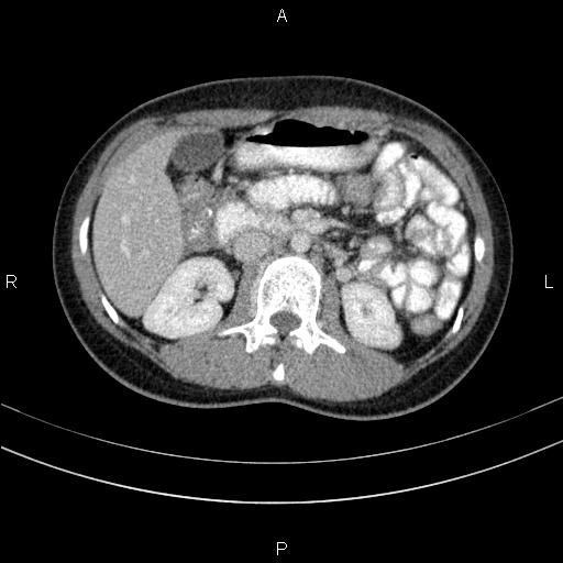 File:Chronic pancreatitis (Radiopaedia 64576-73450 C 67).jpg