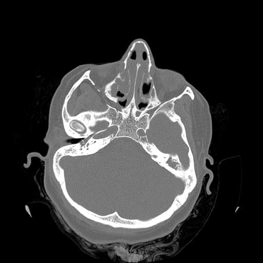 File:Chronic sinusitis with intra-sinus calcification (Radiopaedia 63919-72668 Axial bone window 32).jpg