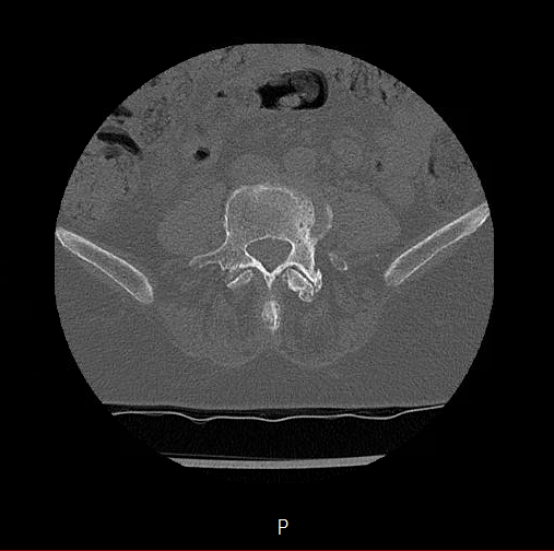 Chronic spinal hematoma with cauda equina syndrome (Radiopaedia 75745-88197 Axial bone window 50).png