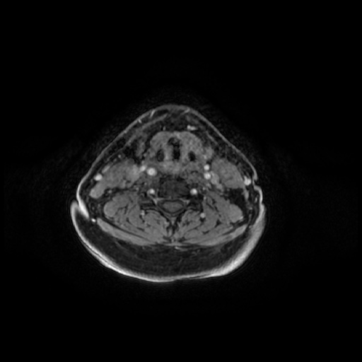 Chronic submandibular sialadenitis (Radiopaedia 61852-69885 Axial T1 C+ fat sat 30).jpg