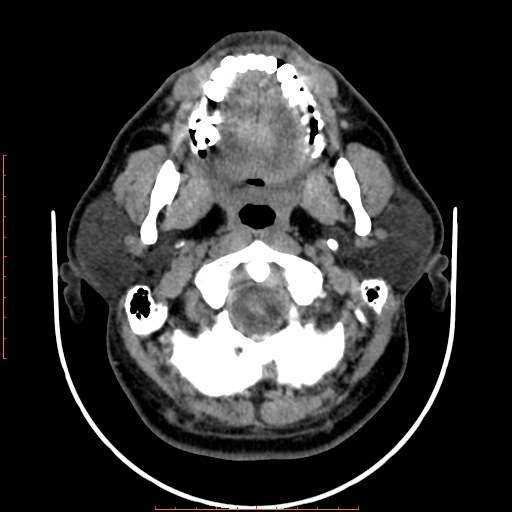 File:Chronic submandibular sialolithiasis (Radiopaedia 69817-79814 Axial non-contrast 54).jpg
