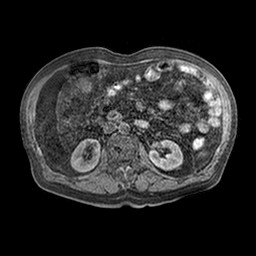 Cirrhosis and hepatocellular carcinoma in the setting of hemochromatosis (Radiopaedia 75394-86594 Axial T1 C+ fat sat 15).jpg