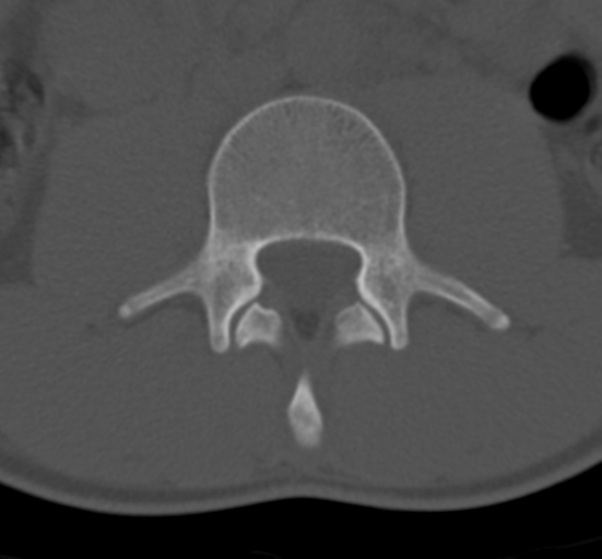 Clear cell meningoma - lumbar spine (Radiopaedia 60116-67691 Axial bone window 36).png