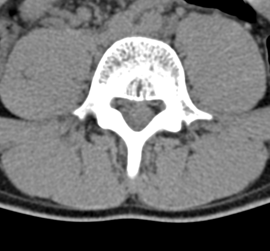 Clear cell meningoma - lumbar spine (Radiopaedia 60116-67691 Axial non-contrast 50).png
