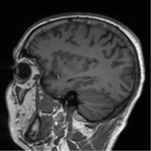 Clival chordoma invading the hypoglossal canal (Radiopaedia 48850-53887 Sagittal T1 31).png