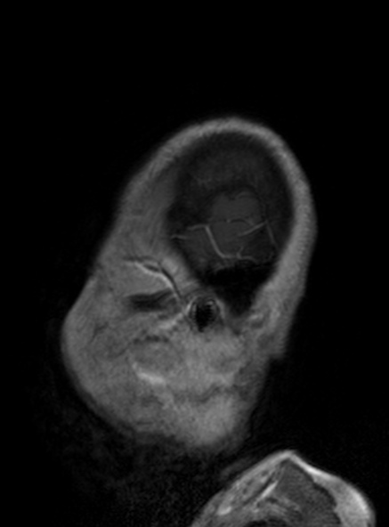 Clival meningioma (Radiopaedia 53278-59248 Sagittal T1 C+ 134).jpg