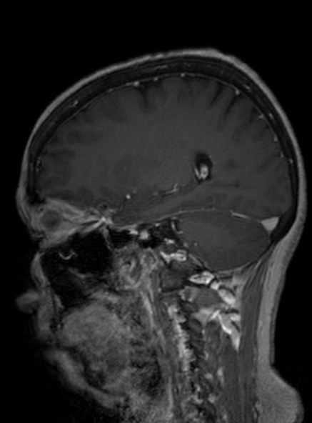 Clival meningioma (Radiopaedia 53278-59248 Sagittal T1 C+ 216).jpg