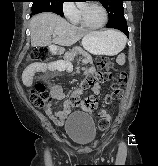 File:Closed loop obstruction - internal hernia into nephrectomy bed (Radiopaedia 59867-67320 B 47).jpg