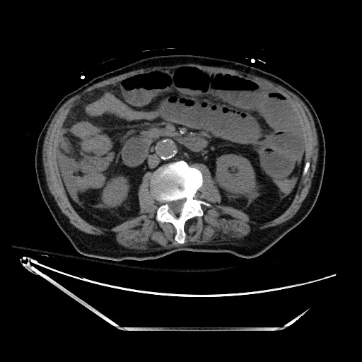File:Closed loop obstruction due to adhesive band, resulting in small bowel ischemia and resection (Radiopaedia 83835-99023 Axial 61).jpg