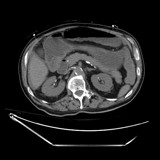File:Closed loop obstruction due to adhesive band, resulting in small bowel ischemia and resection (Radiopaedia 83835-99023 Axial non-contrast 55).jpg