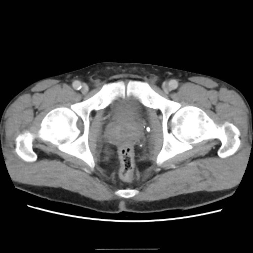 File:Closed loop small bowel obstruction (Radiopaedia 59227-66554 A 82).jpg