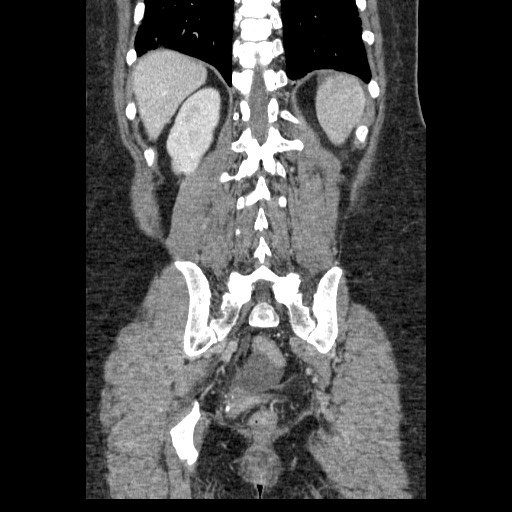 Closed loop small bowel obstruction (Radiopaedia 65403-74451 B 82).jpg