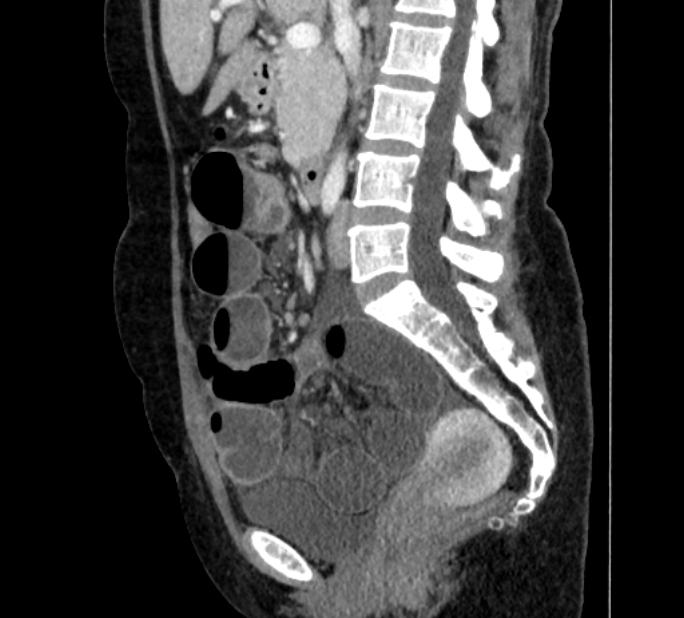 Closed loop small bowel obstruction (Radiopaedia 71211-81508 C 70).jpg